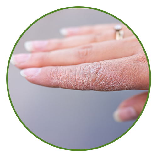 Dry skin
