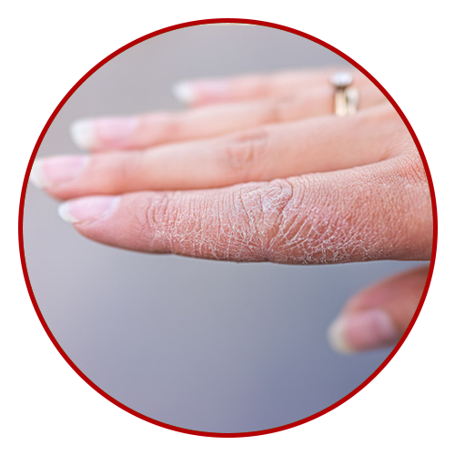 Dry skin